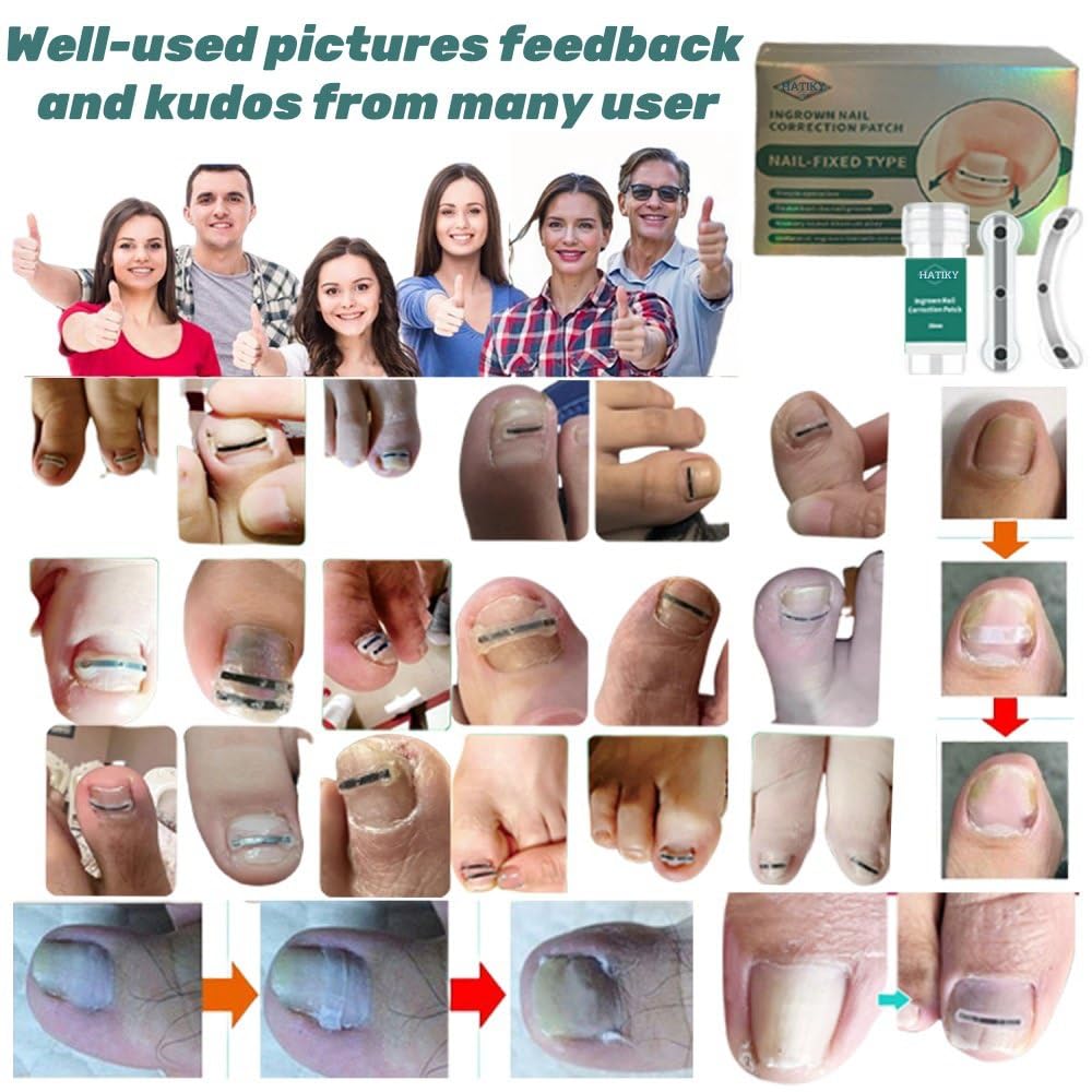 Ingrown Toenail Corrector & Removal Kit - at Home Treatment for Ingrown Toenails, Titanium Alloy Ingrown Toenail Treatment Tools, Nail Tools Designed for Curved Nail Repair Suitable for Men Woman
