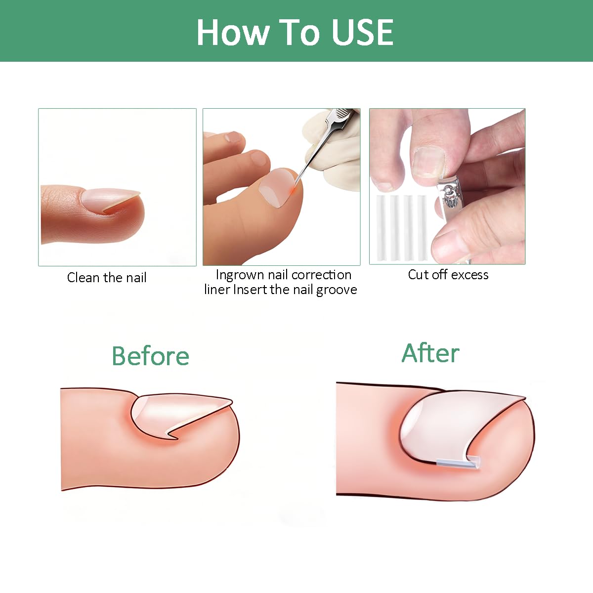 tituouou Professional Ingrown Toenail Treatment Set with Breathable Ingrown Toenail Strips,Ingrown Toenail Removal Kit,Curved Toenails Corrector Patch, Ingrown Toenail Corrector Tool Set for Home Use