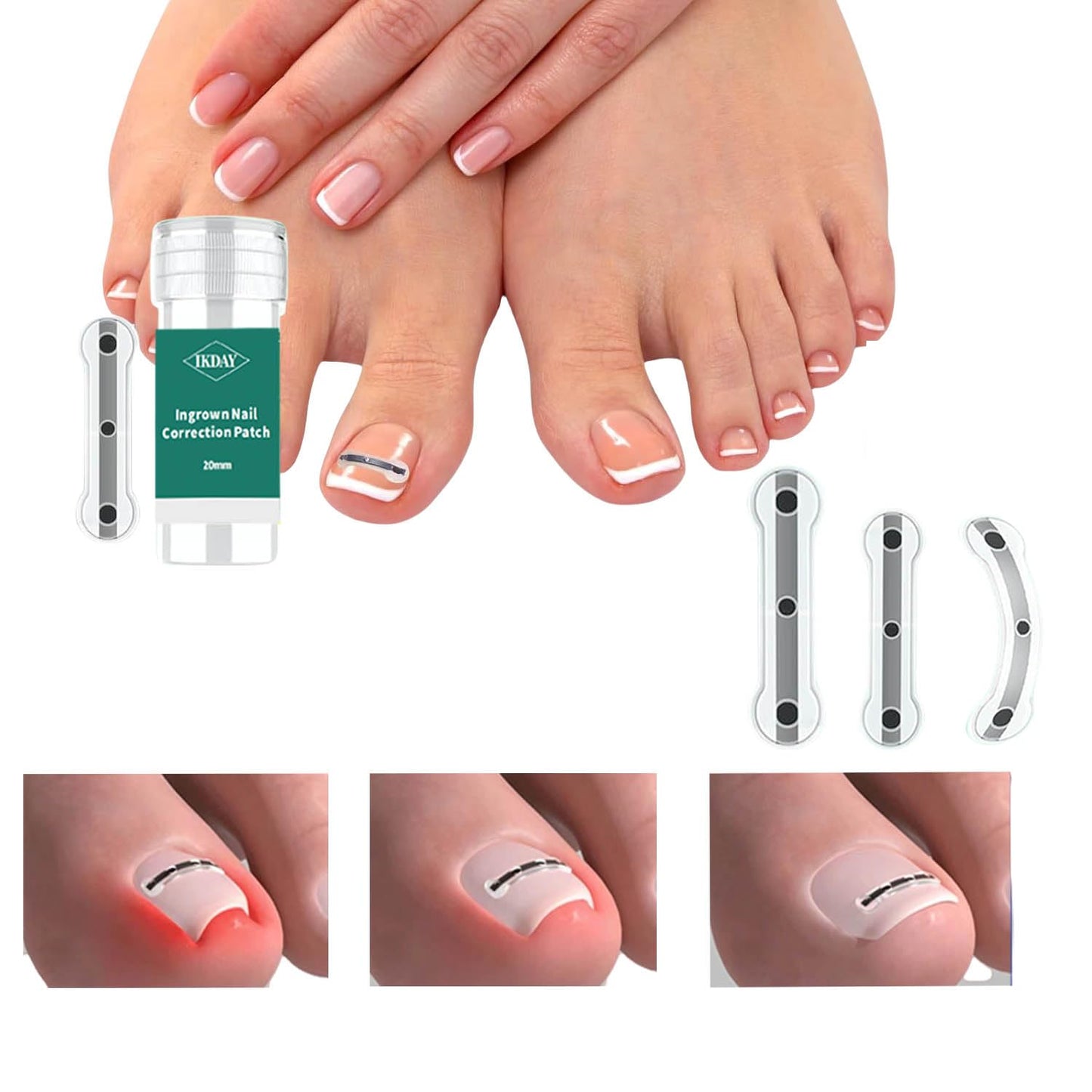 Ingrown Toenail Treatment & Removal Kit - at Home Treatment for Ingrown Toenails, Titanium Alloy Ingrown Toenail Corrector, Nail Tools for Curved Nail Repair Suitable for Men Woman (((0.67/0.79in)))