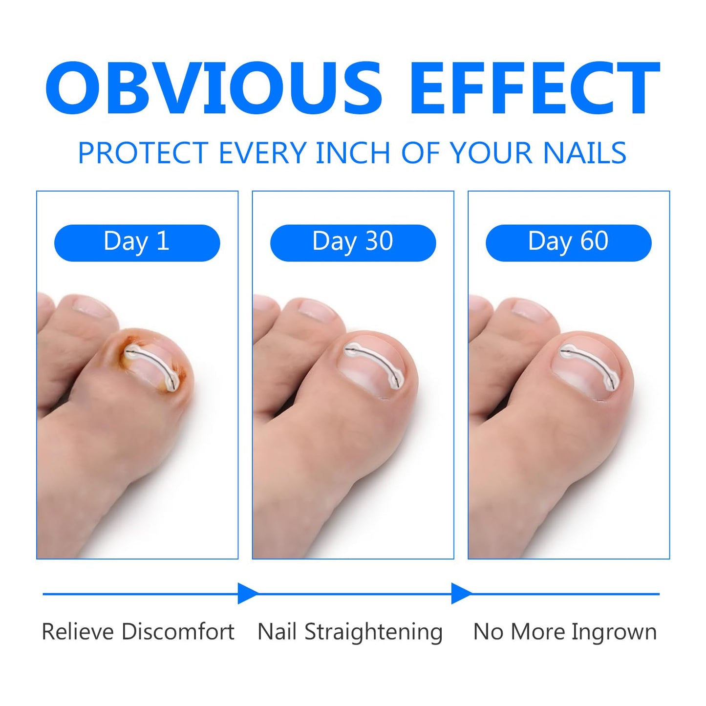 Ingrown Toenail Treatment, Toenail Correction Strips for Curved or Ingrown Nails, Ingrown Toe Nail Relief Remover Strips, Quick Relief, Nail Correction, 5 Different Sizes