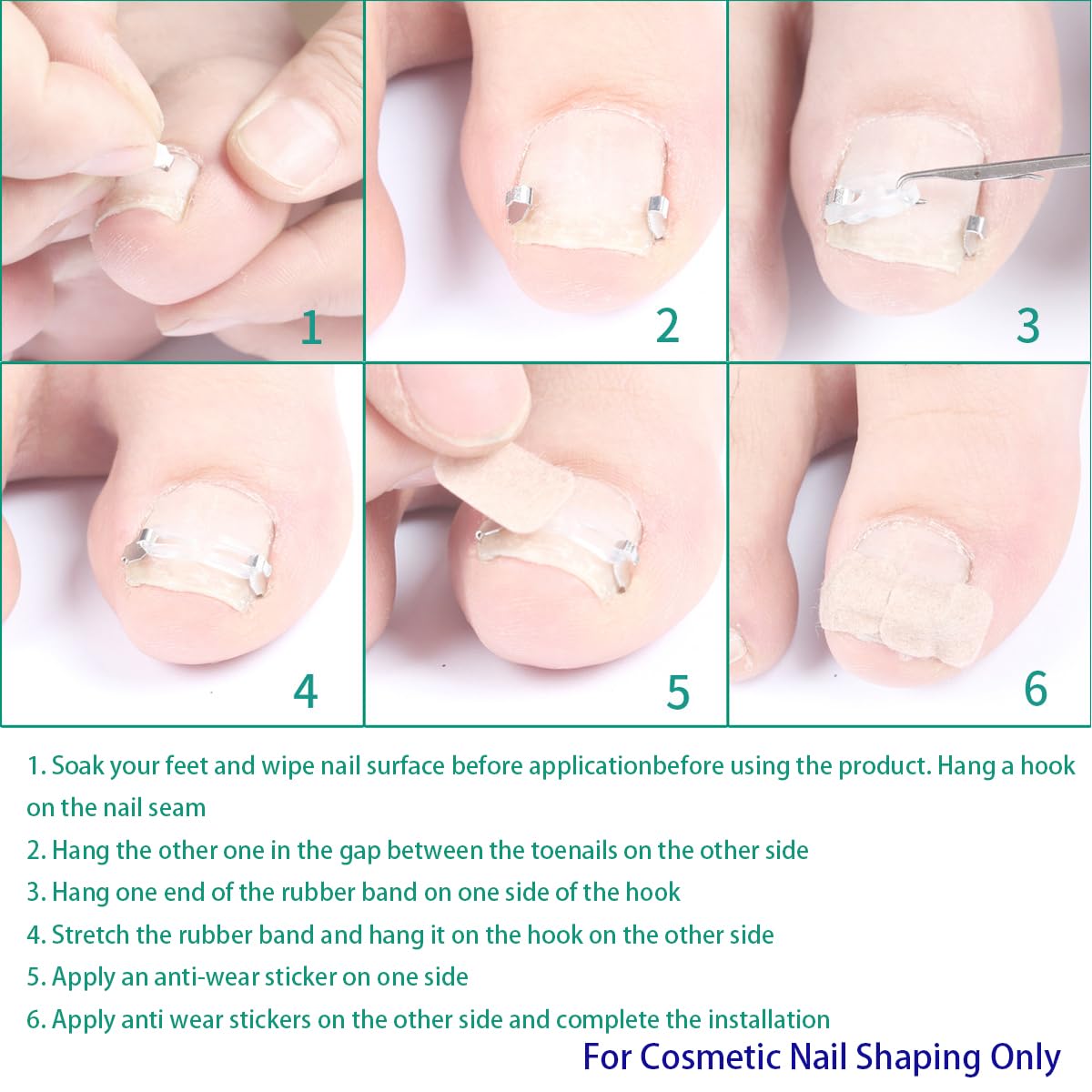 JIUDOUCUOIngrown Toenail correction Kit, Professional Nail Care Tools with Correction Clips and Adhesive Pads，Four correction clips can correct two toenails simultaneously