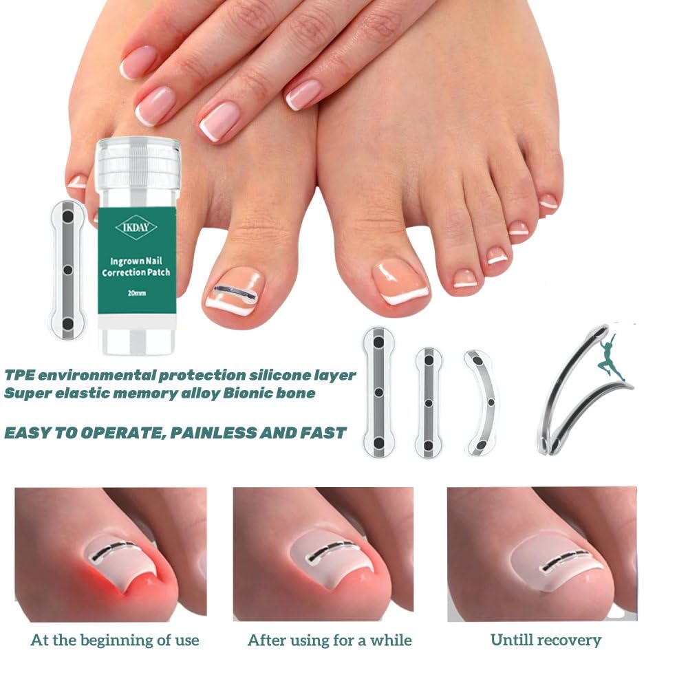Ingrown Toenail Removal Kit | Titanium Alloy Ingrown Toenail Treatment | Pedicure Tools for Feet, Nail Tools Specially Designed for Curved Nail Repair and Ingrown Toenail Corrector (0.67/0.79in)