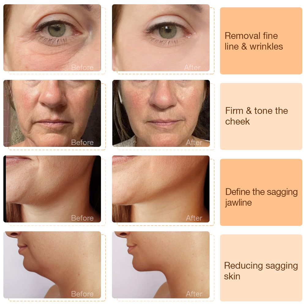 Skin Tightening Device | 6 in 1 Radio Frequency Skin Tightening Device | Professional Face Tightening | Lifting | Wrinkle Reducing | Depuff | Absorb | at Home RF Anti Aging Face Beauty Device