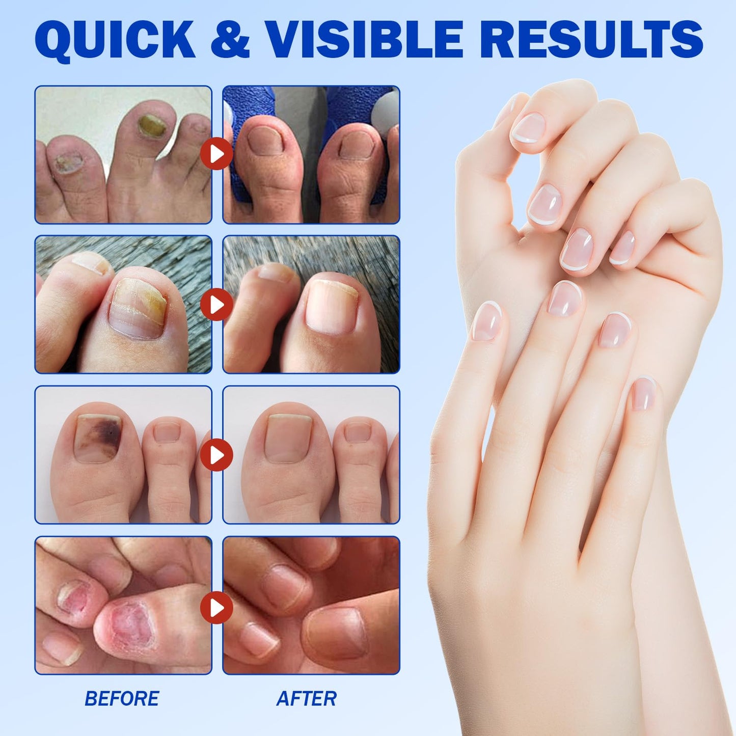 Nail Patches 21 PCS Toenail Treatment Extra Strength 8-Hour Fast Acting Repair Damaged Nails Overnight Nail Repair Effortless Hydrogel Nail Care Renewal for Men and Women