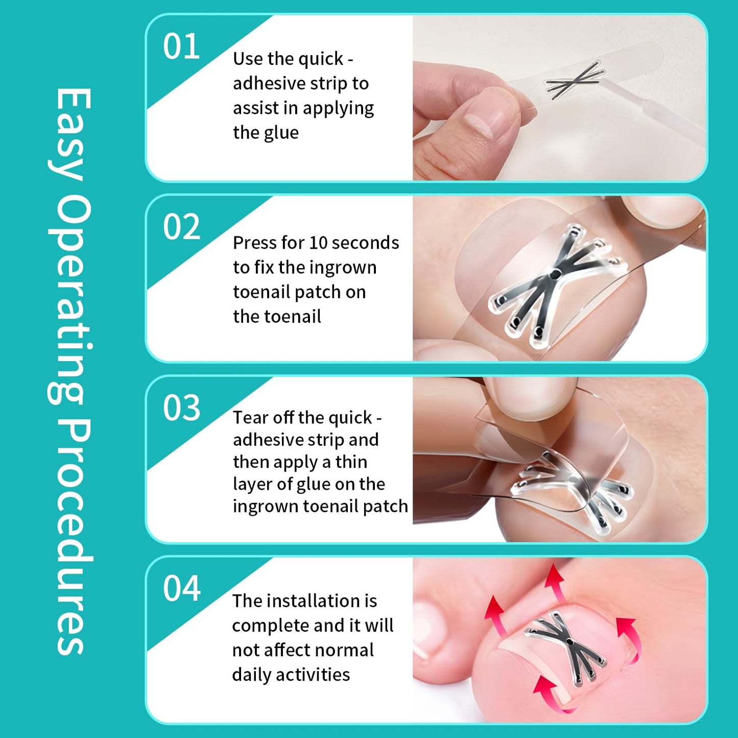 Upgraded Titanium Alloy Ingrown Toenail Corrector with Upgraded 6-Angle Shape,3x Stronger Pull Force,Ingrown Toenail Removal Kit, Ingrown Toenail Treatment for Women and Man