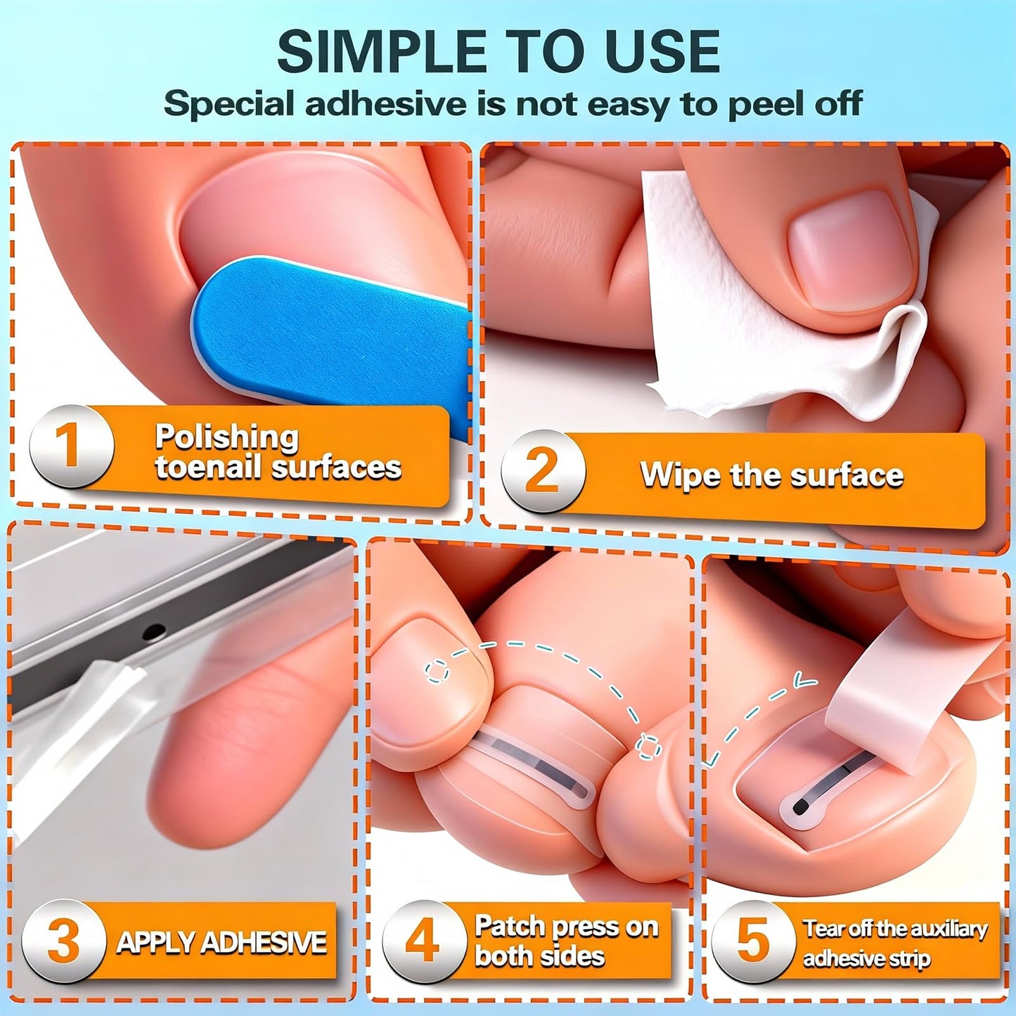 Titanium Alloy Ingrown Toenail Treatment - Professional Home Care for Curved Nails - Waterproof, Nail Tools and Ingrown Toenail Removal Kit,Ingrown Toenail Corrector(0.59/0.67in)