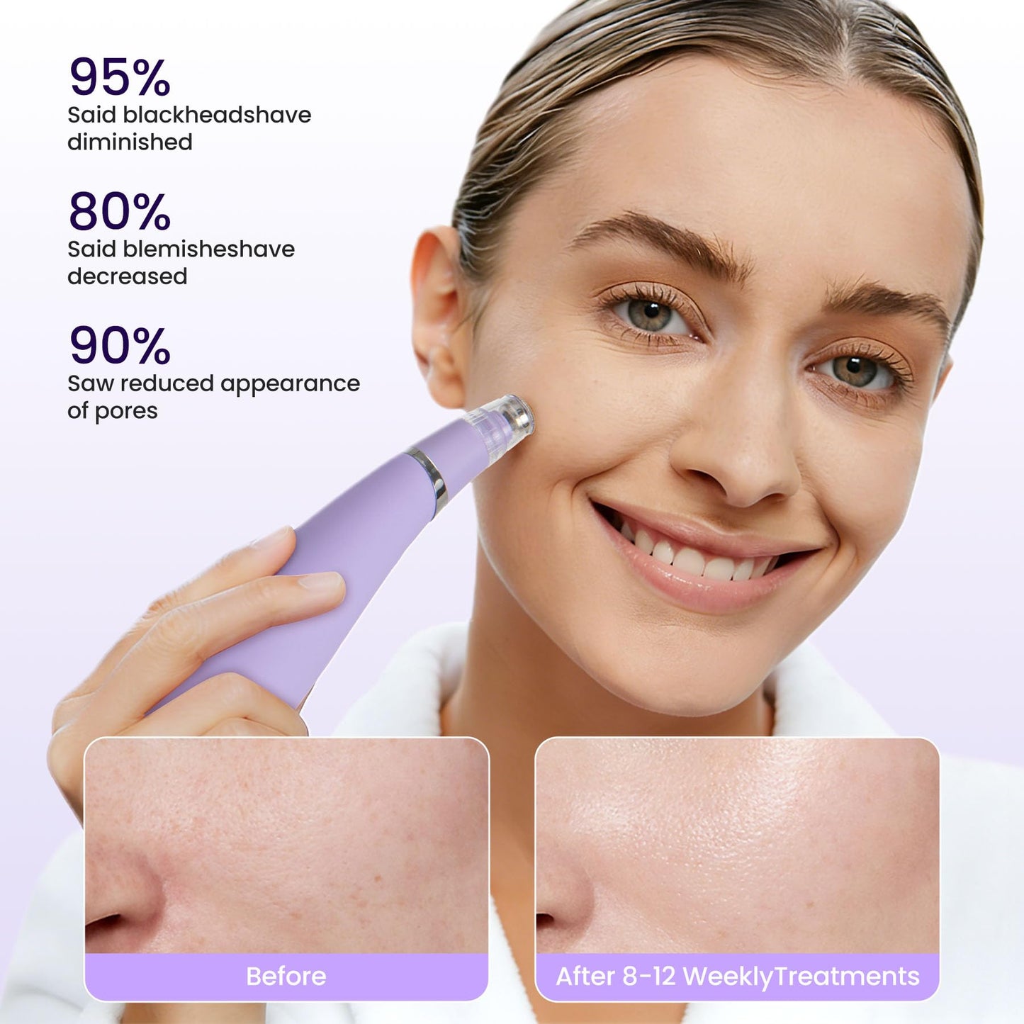 UNOISETION Diamond Microdermabrasion Machine，4 Modes Diamond Microdermabrasion Dermabrasion Machine Tool- - 2 Diamond Tips - 3 Heads - Blackhead Blemishes Remover（Purple）