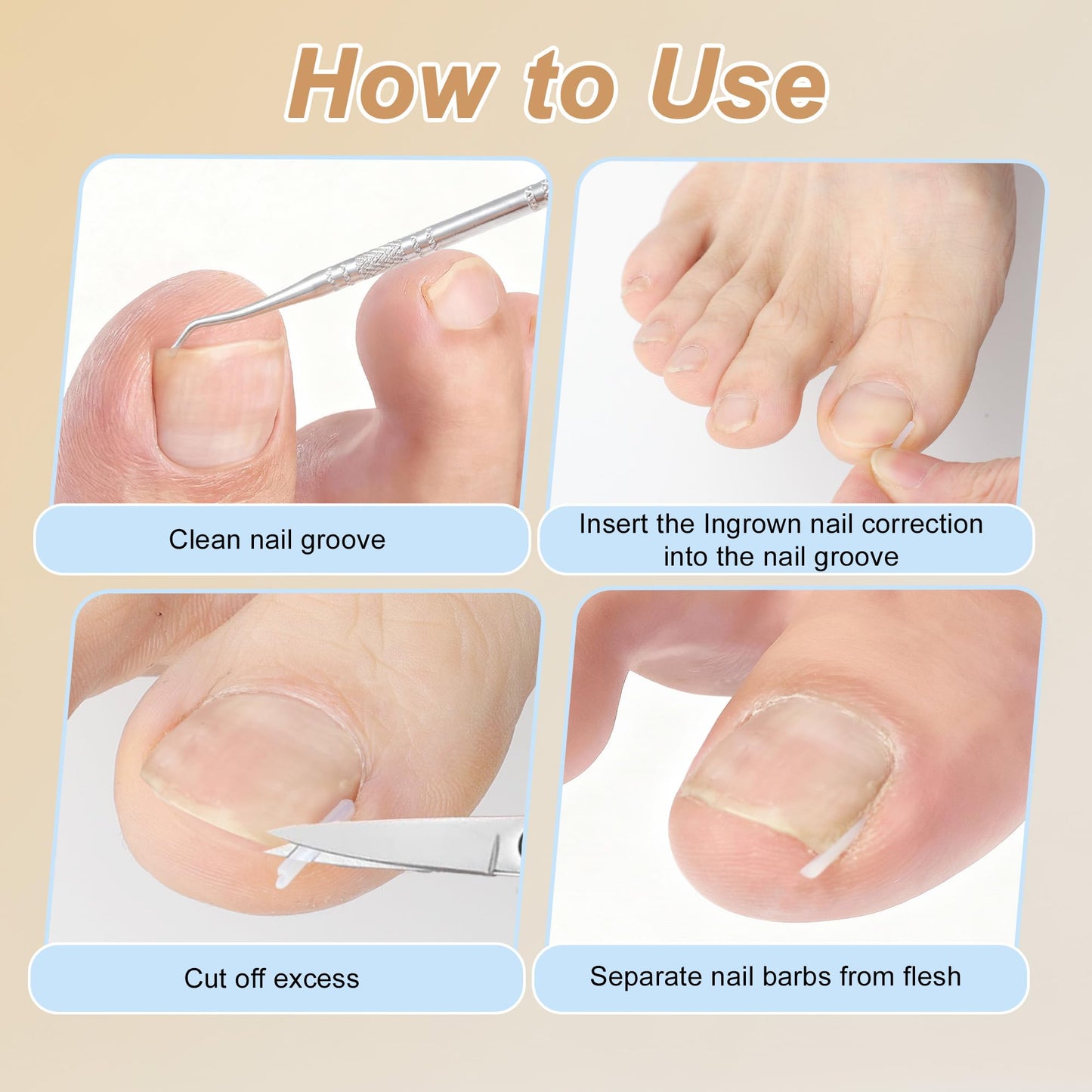 VOCOSTE Ingrown Toenail Correction Kit, Toe Nail Corrector Tools with Leather Case for Easy Storage & Travel, for Curved & Ingrown Nails with Nail Files Clipper Lifter