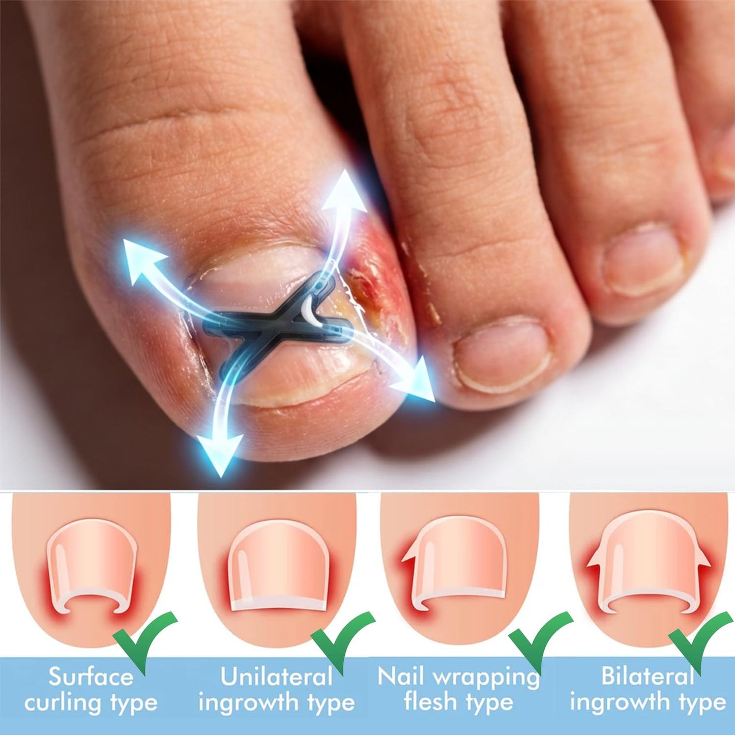 CHGRNLF Ingrown Toenail Treatment Kit, Titanium Alloy Ingrown Toenail Corrector Strips for Big Toe, Toenail Curve Corrector & Straightener for Curled Nails, At-Home Ingrown Nail Pain Relief, 6Pcs
