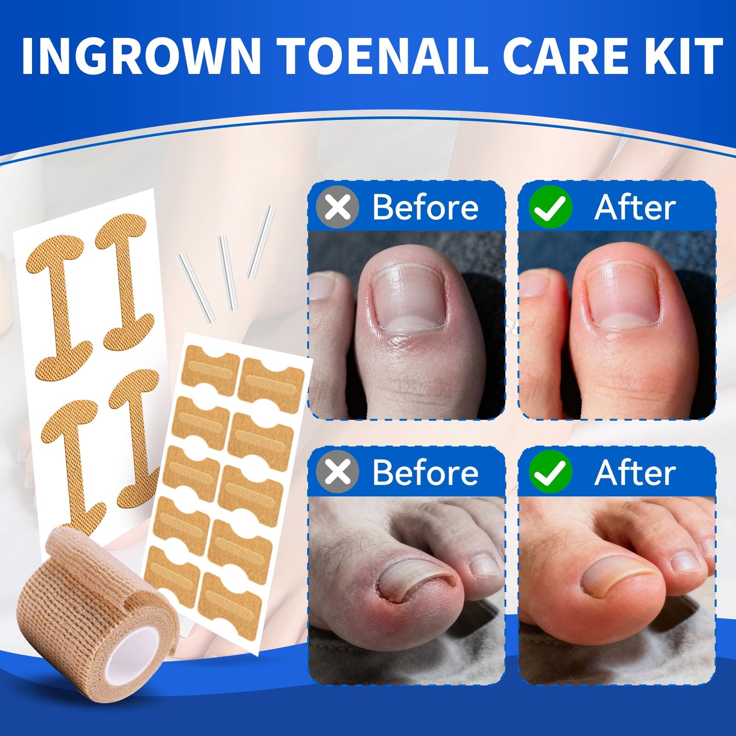 Ingrown Toenail Care Kit with Flexible Strips(134PCS), Professional Toenail Tool Kit Includes Breathable Toenail Bands, Curved Pads, Painless File & Lifter Tools | Home Pedicure Maintenance Set