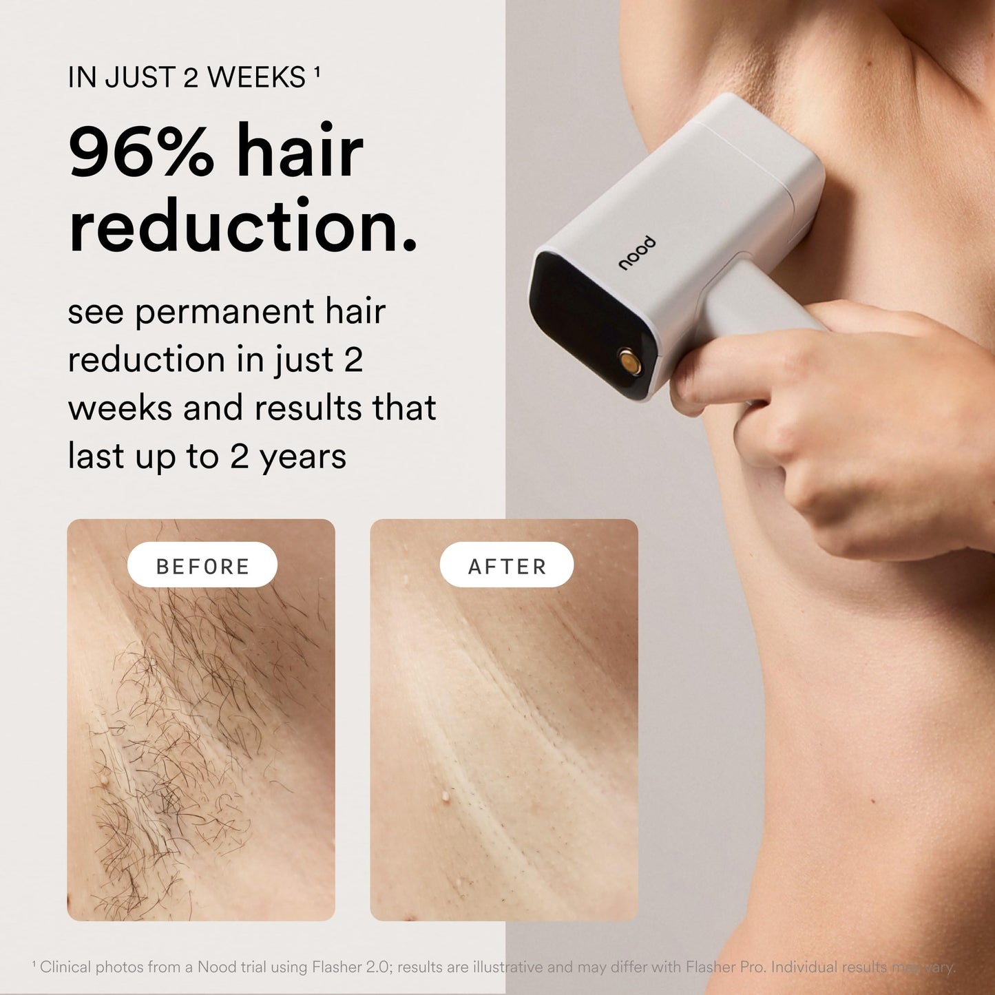 Nood™ NEW Flasher Pro — IPL Laser Hair Removal Device & Anti-Aging Red Light Therapy for Women & Men — Pain-free, Permanent, Visible Results After First Use & Works Everywhere Hair Grows — Gloss White