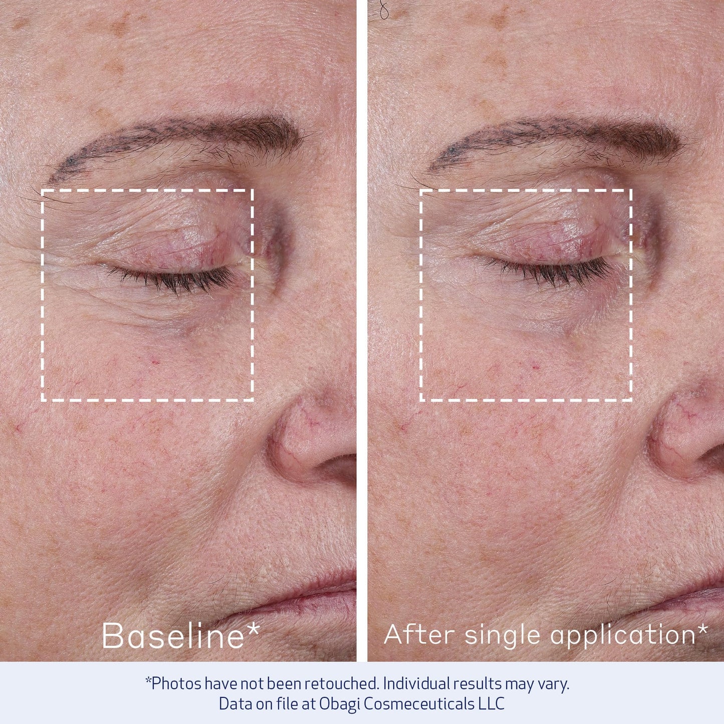 Obagi ELASTIderm Advanced Filler Concentrate – Clinically Proven Non-Injectable Filler with Biomimetic Peptide Technology that Firms Skin & Reduces the Appearance of Fine Lines & Wrinkles – 0.68 oz